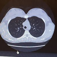 Normal lungs