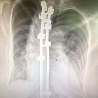 Back lungs