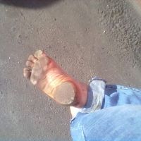 callused sole